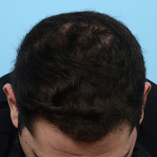 Fue Before and After | Dr. Jeffrey Wise