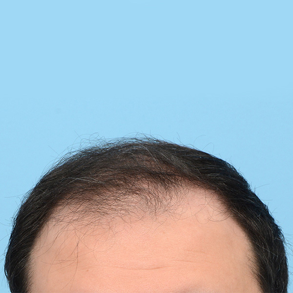 Fue Before and After | Dr. Jeffrey Wise