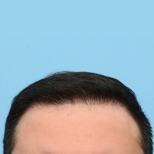 Fue Before and After | Dr. Jeffrey Wise