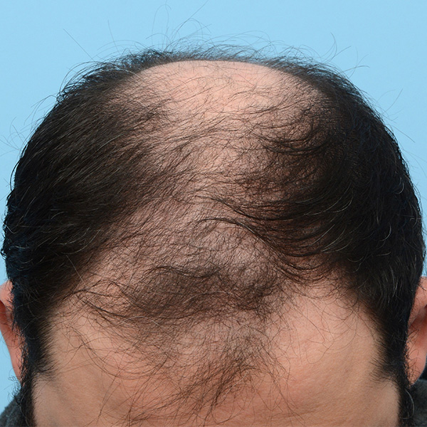 Fue Before and After | Dr. Jeffrey Wise