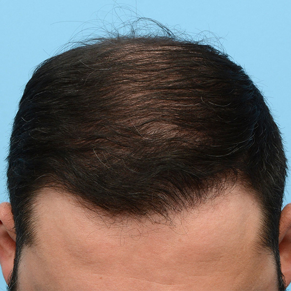 Fue Before and After | Dr. Jeffrey Wise