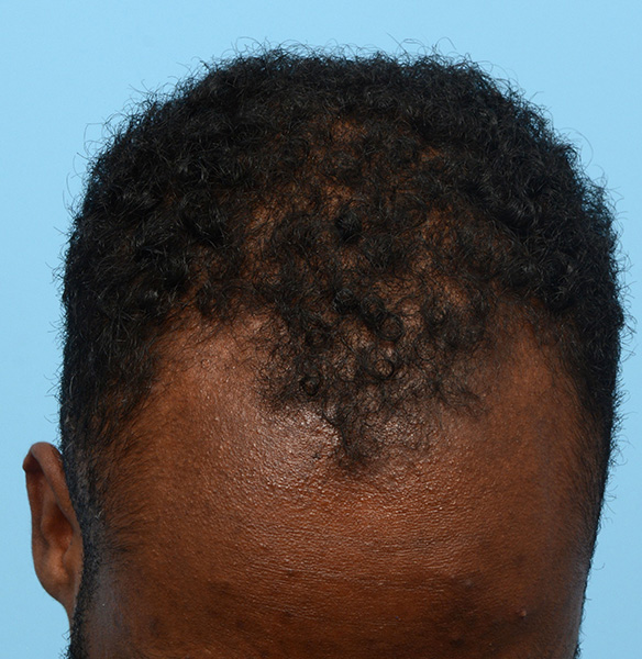 Fue Before and After | Dr. Jeffrey Wise