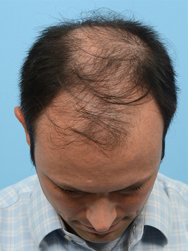 Fue Before and After | Dr. Jeffrey Wise