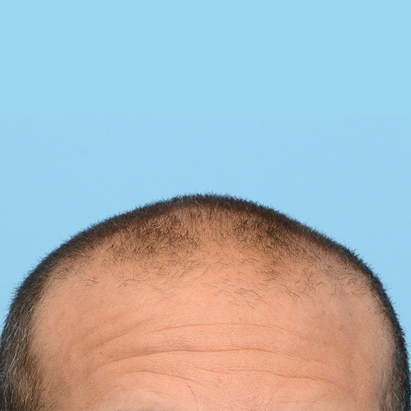 Fue Before and After | Dr. Jeffrey Wise