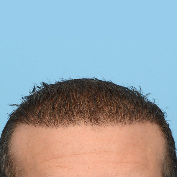 Fue Before and After | Dr. Jeffrey Wise