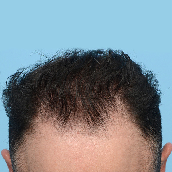 Fue Before and After | Dr. Jeffrey Wise