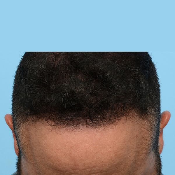 Fue Before and After | Dr. Jeffrey Wise