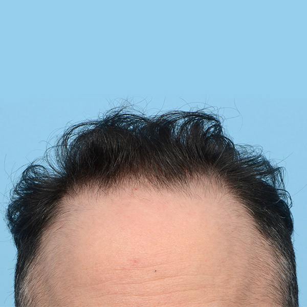 Fue Before and After | Dr. Jeffrey Wise