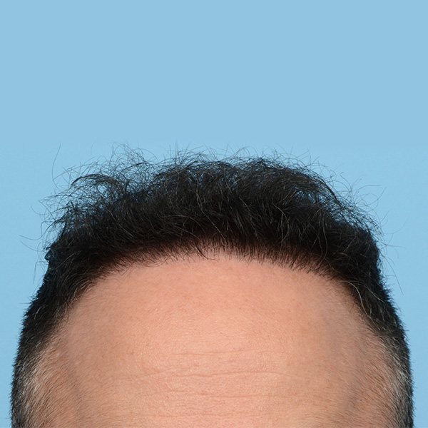 Fue Before and After | Dr. Jeffrey Wise