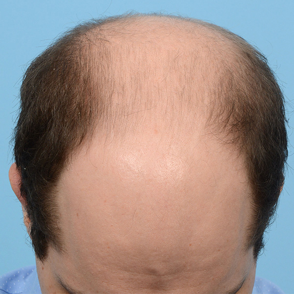 Fue Before and After | Dr. Jeffrey Wise