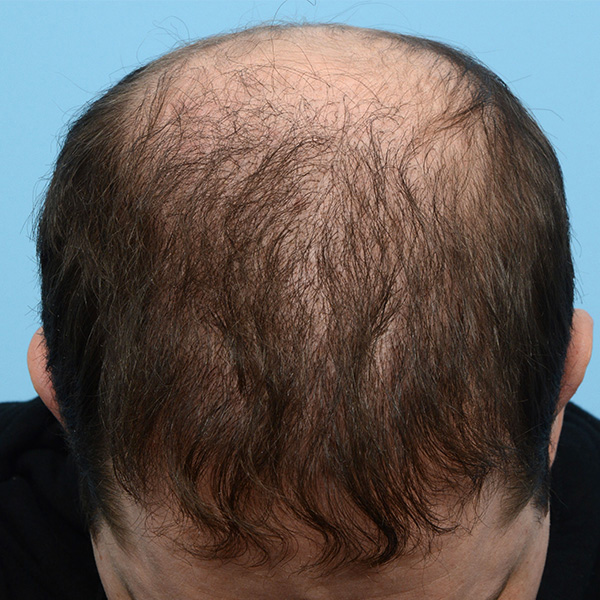 Fue Before and After | Dr. Jeffrey Wise