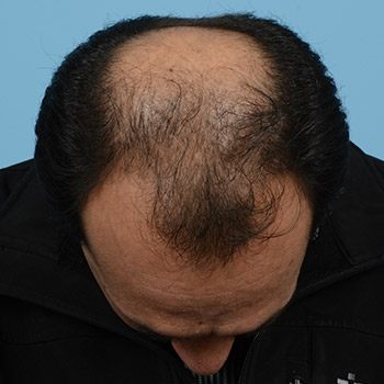 Fue Before and After | Dr. Jeffrey Wise