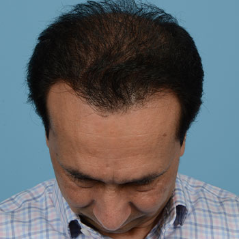 Fue Before and After | Dr. Jeffrey Wise