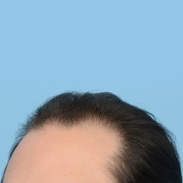 Fue Before and After | Dr. Jeffrey Wise