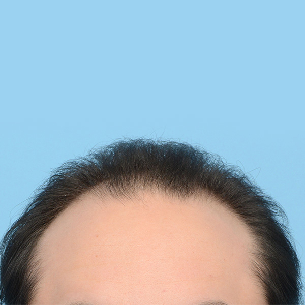 Fue Before and After | Dr. Jeffrey Wise