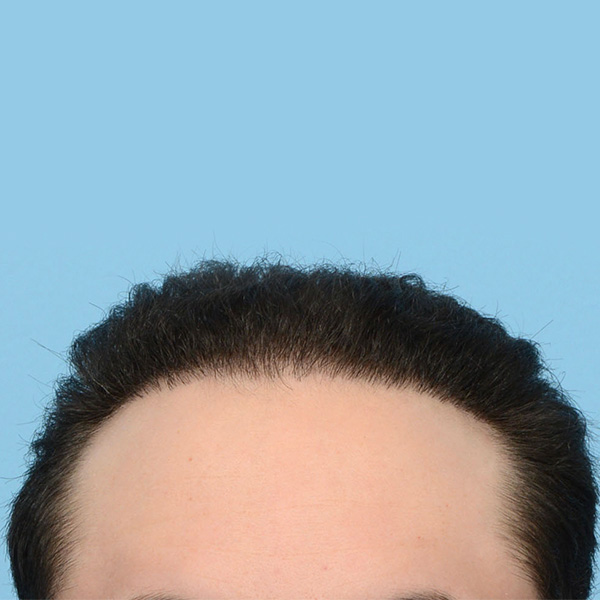 Fue Before and After | Dr. Jeffrey Wise