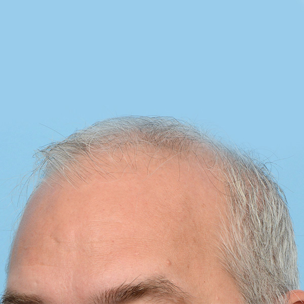 Fue Before and After | Dr. Jeffrey Wise