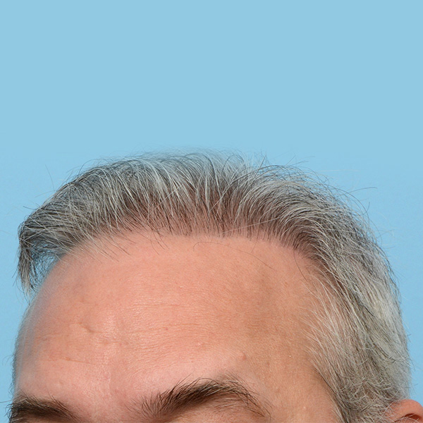 Fue Before and After | Dr. Jeffrey Wise