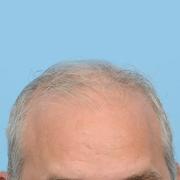 Fue Before and After | Dr. Jeffrey Wise