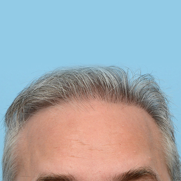 Fue Before and After | Dr. Jeffrey Wise