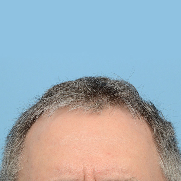 Fue Before and After | Dr. Jeffrey Wise