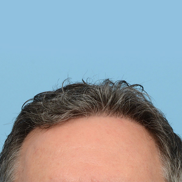 Fue Before and After | Dr. Jeffrey Wise