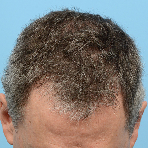 Fue Before and After | Dr. Jeffrey Wise