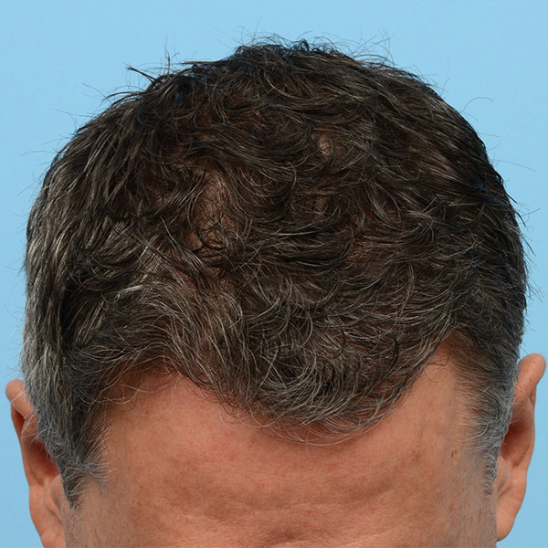 Fue Before and After | Dr. Jeffrey Wise