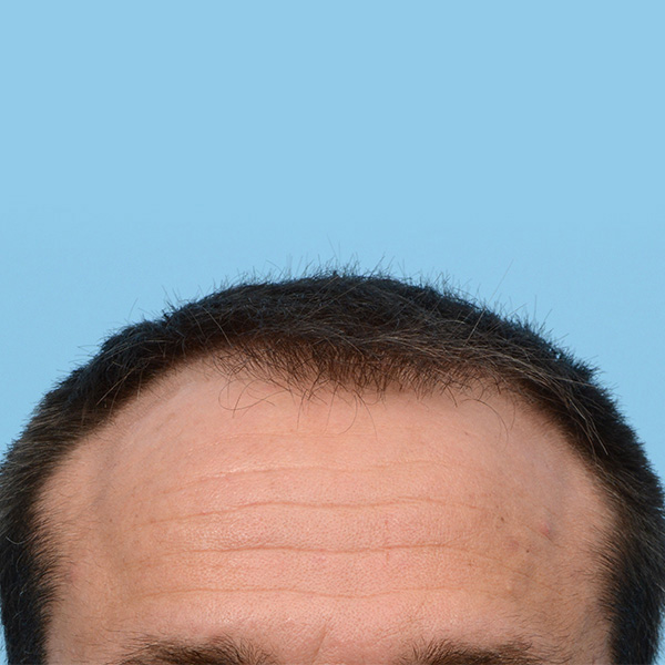 Fue Before and After | Dr. Jeffrey Wise