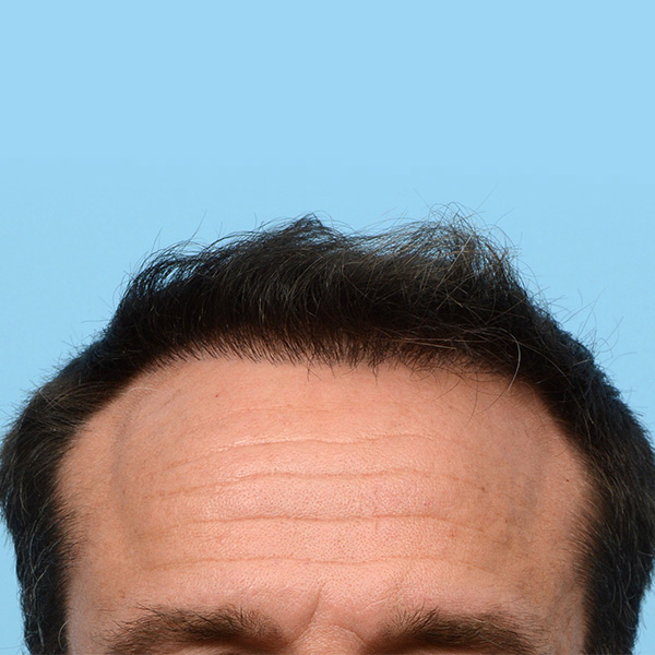 Fue Before and After | Dr. Jeffrey Wise