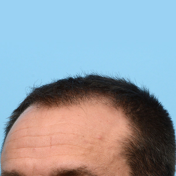 Fue Before and After | Dr. Jeffrey Wise