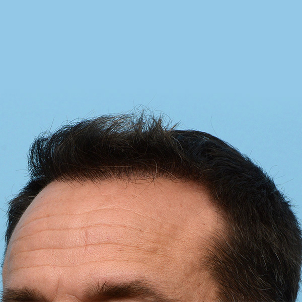 Fue Before and After | Dr. Jeffrey Wise