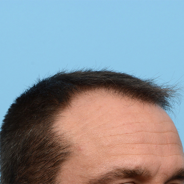 Fue Before and After | Dr. Jeffrey Wise