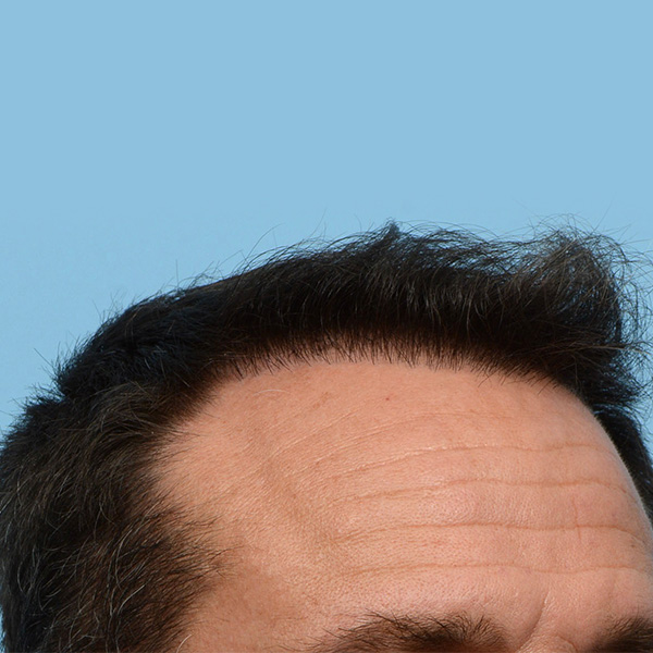 Fue Before and After | Dr. Jeffrey Wise