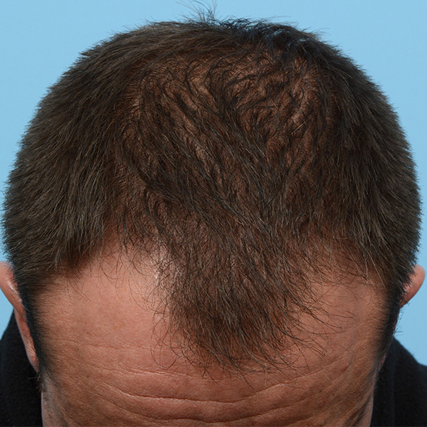 Fue Before and After | Dr. Jeffrey Wise