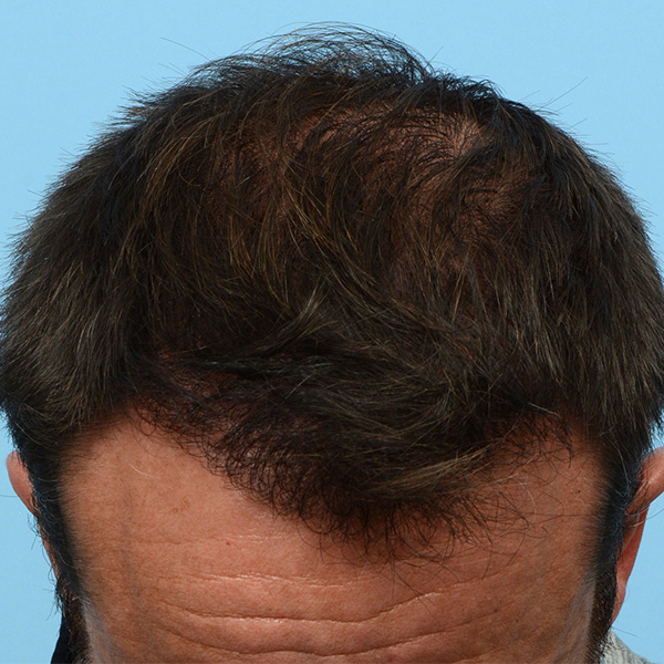 Fue Before and After | Dr. Jeffrey Wise