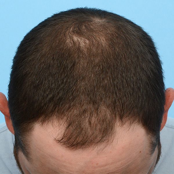 Fue Before and After | Dr. Jeffrey Wise