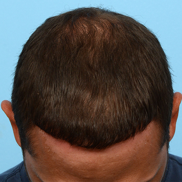 Fue Before and After | Dr. Jeffrey Wise