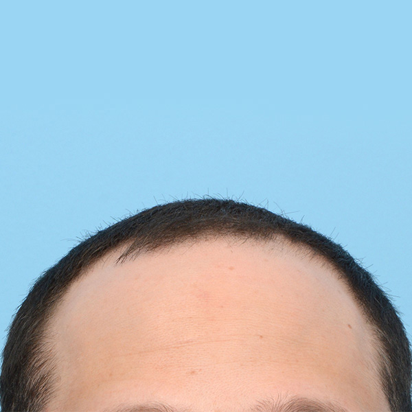 Fue Before and After | Dr. Jeffrey Wise