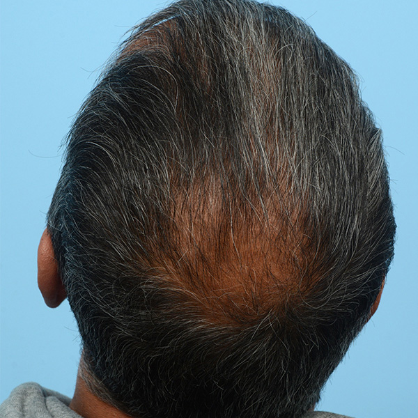 Fue Before and After | Dr. Jeffrey Wise