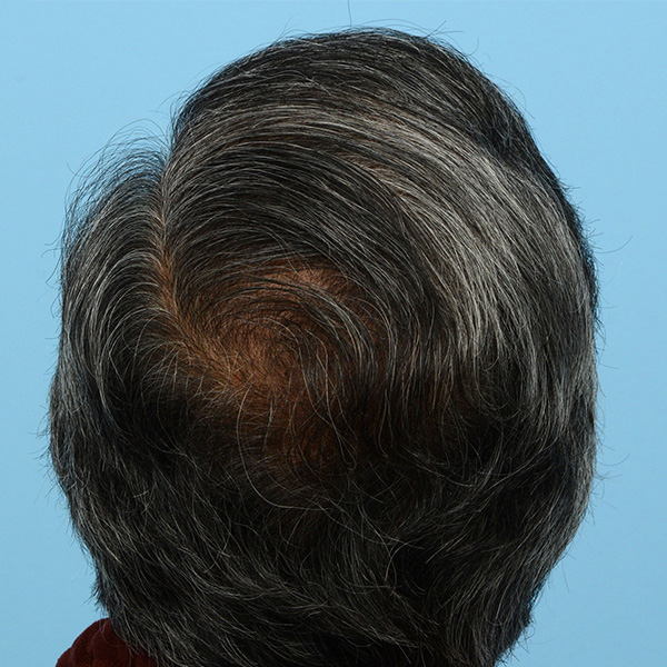 Fue Before and After | Dr. Jeffrey Wise