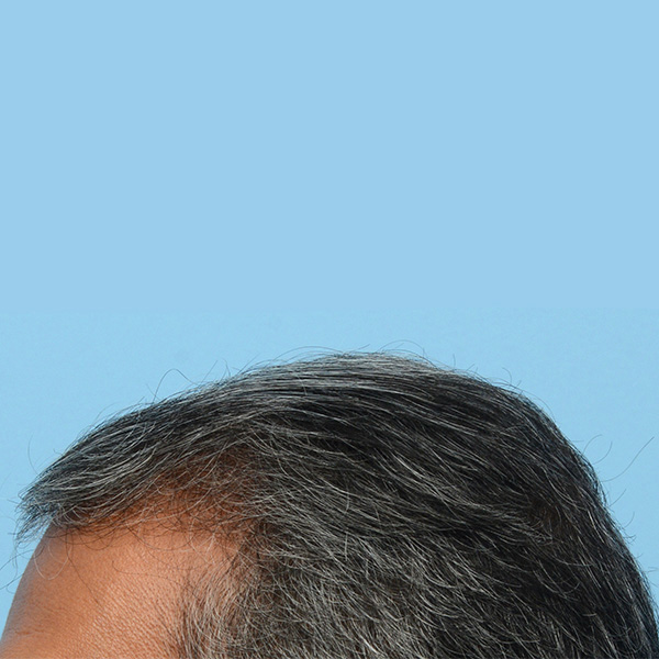 Fue Before and After | Dr. Jeffrey Wise