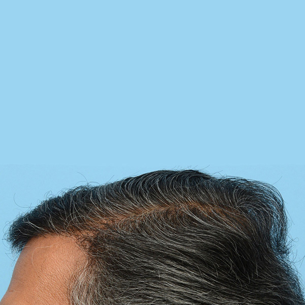 Fue Before and After | Dr. Jeffrey Wise