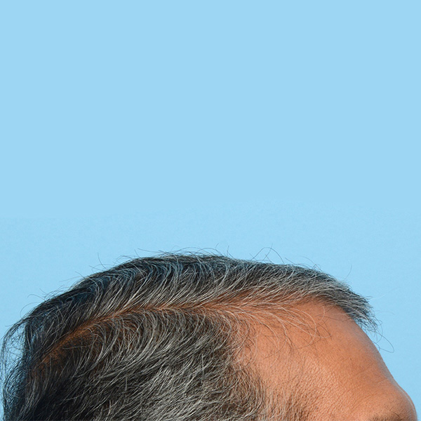 Fue Before and After | Dr. Jeffrey Wise