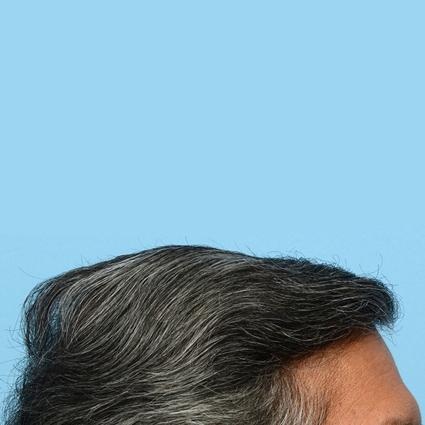 Fue Before and After | Dr. Jeffrey Wise