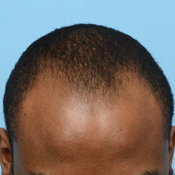 Fue Before and After | Dr. Jeffrey Wise