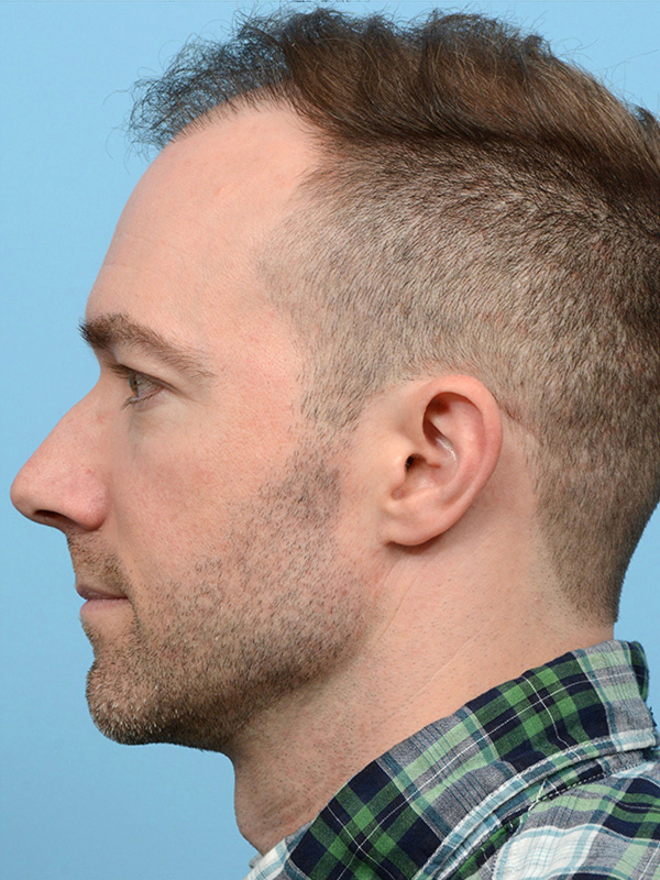 Fue Before and After | Dr. Jeffrey Wise