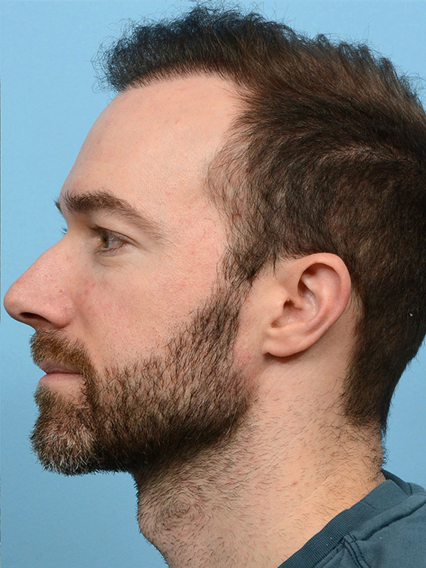 Fue Before and After | Dr. Jeffrey Wise