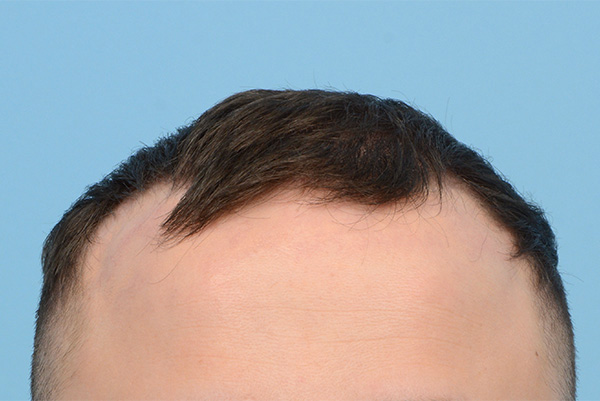 Fue Before and After | Dr. Jeffrey Wise