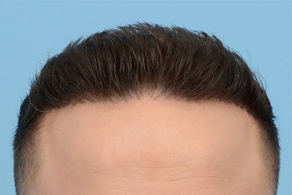 Fue Before and After | Dr. Jeffrey Wise